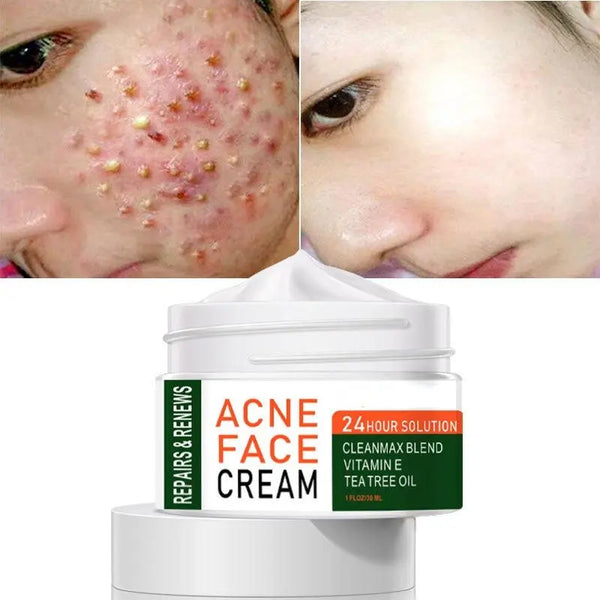 best face cream for acne