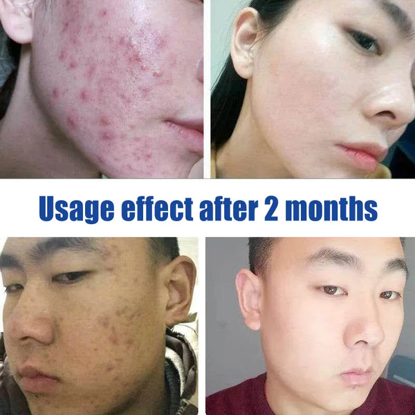 acne serum